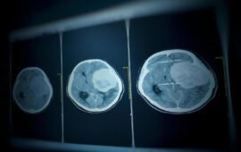 CGI and Helsinki University Hospital develop AI solution for reviewing brain CT scans and detecting brain hemorrhages